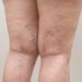 What Your Legs Might Be Telling You: 7 Early Signs of Poor Circulation You Shouldn’t Ignore