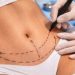 Understanding Body Contouring: Tummy Tuck and Liposuction After Weight Changes