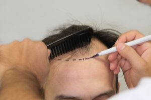 Top 10 Things to Know Before Getting a Hair Transplant in Turkey