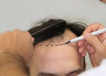 Top 5 Hair Transplant Clinics in Turkey for Celebrity-Grade Results