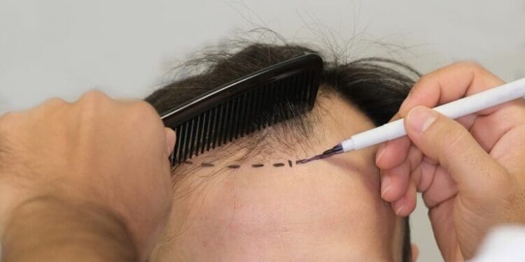 Top 5 Hair Transplant Clinics in Turkey for Celebrity-Grade Results
