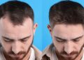 Top 10 Best Hair Transplant Doctors in Turkey: A 2026 Guide to Surgeons