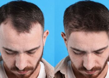 Top 10 Best Hair Transplant Doctors in Turkey: A 2026 Guide to Surgeons