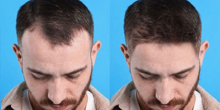 Top 10 Best Hair Transplant Doctors in Turkey: A 2026 Guide to Surgeons