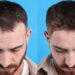 Top 10 Best Hair Transplant Doctors in Turkey: A 2026 Guide to Surgeons