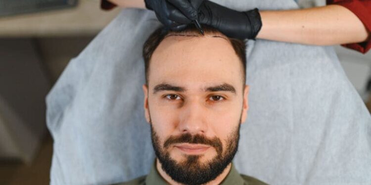 Top 10 Best Hair Transplant in Turkey