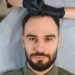 Top 10 Best Hair Transplant in Turkey
